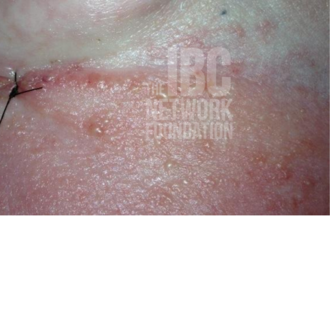 Pictures of Inflammatory Breast Cancer - The IBC Network Foundation
