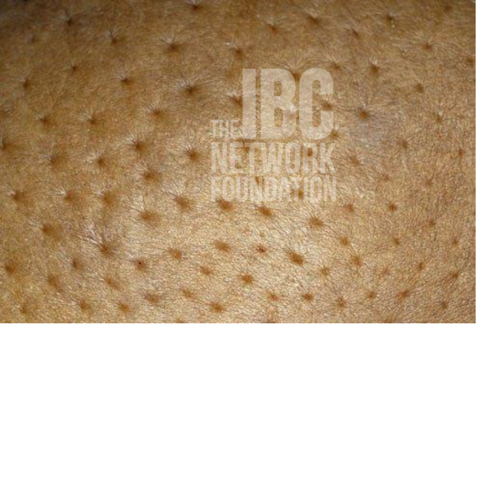 Pictures of Inflammatory Breast Cancer The IBC Network Foundation