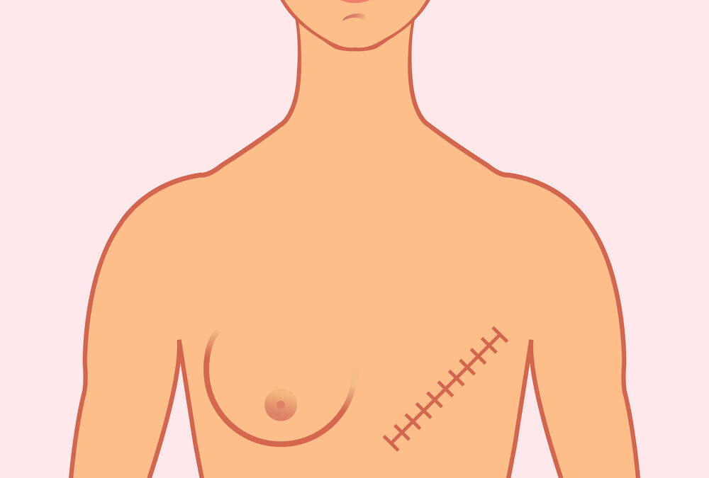 Simple Mastectomy or Modified Radical Mastectomy for Stage 4 IBC