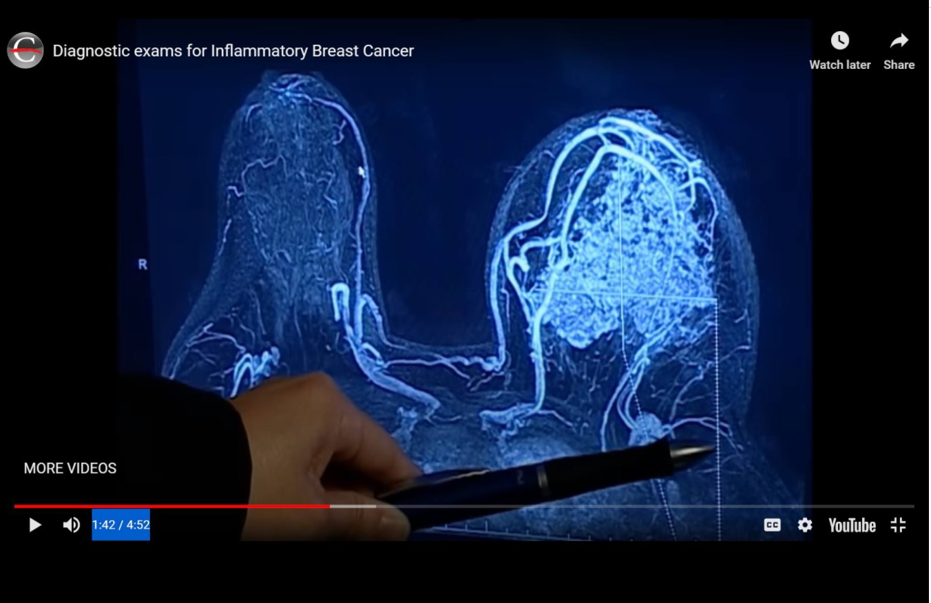 inflammatory breast cancer MRI